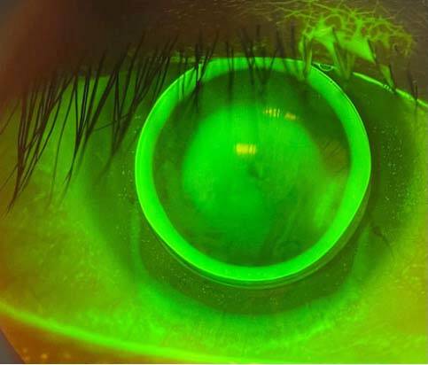 Figure 4. Adaptation de la LRPG avec traitement de la surface oculaire : lentille bien centrée avec une belle image fluorescéinique.

