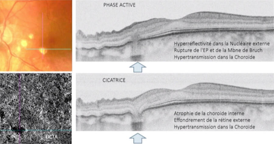 Figure 3. Clichés couleur, OCT-A et SD-OCT représentant les caractéristiques de la phase active et cicatricielle des lésions de choroïdite multifocale chez le myope (d’après la communication d’Alain Gaudric).