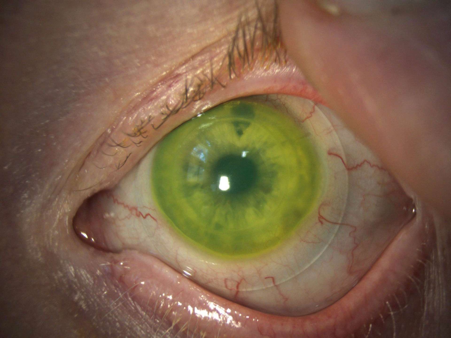 Figure 1. Lentille sclérale (Time XL diamètre 16,50 mm, Menicon) chez un patient avec une greffe de cornée de l’œil gauche pour un kératocône. Son acuité visuelle est passée de 3/10 en lunettes à 10/10 avec la lentille. 
