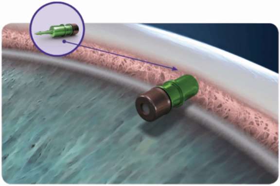 Figure 3. iDose® (source : Glaukos).