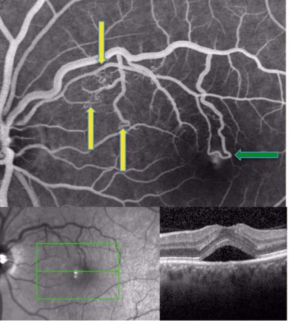 Figure 3. Angiographie à la fluorescéine et OCT maculaire du second cas.