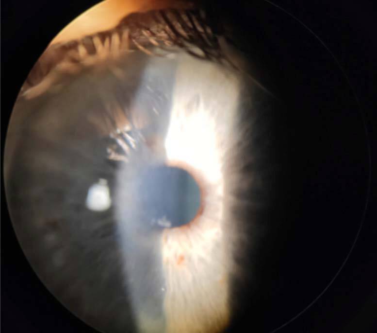 Figure 2. Examen en lampe à fente mettant en évidence une dystrophie de Cogan, respectivement à l’œil gauche. 
