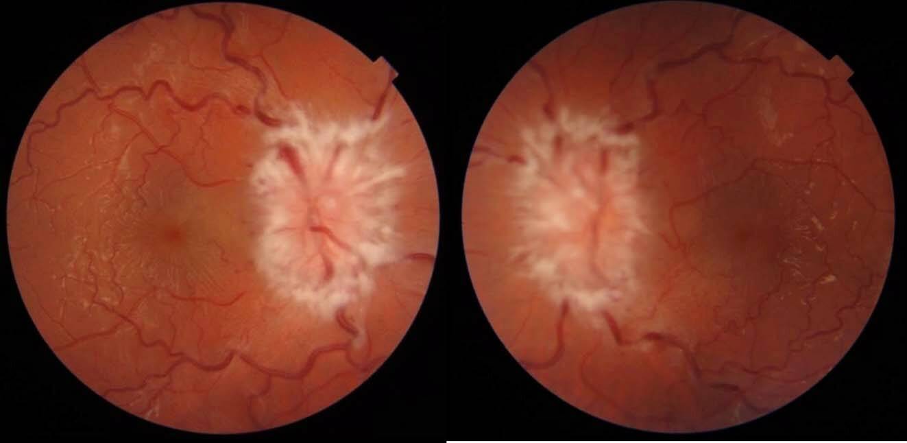 Figure 1. Rétinophotographies des 2 yeux, œdème papillaire de grade 4 bilatéral (Topcon Dri OCT Triton plus – CHBA Vannes, service d’ophtalmologie).
