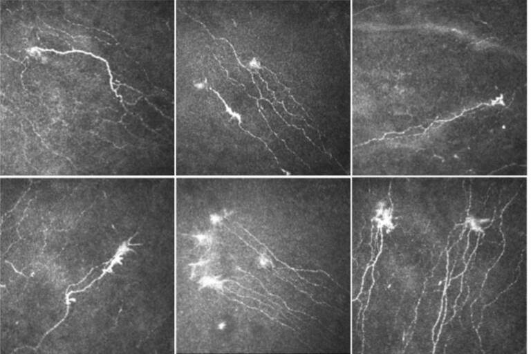 Figure 3. Névromes des nerfs du plexus sous-basal chez des patients atteints d’une sécheresse oculaire.
