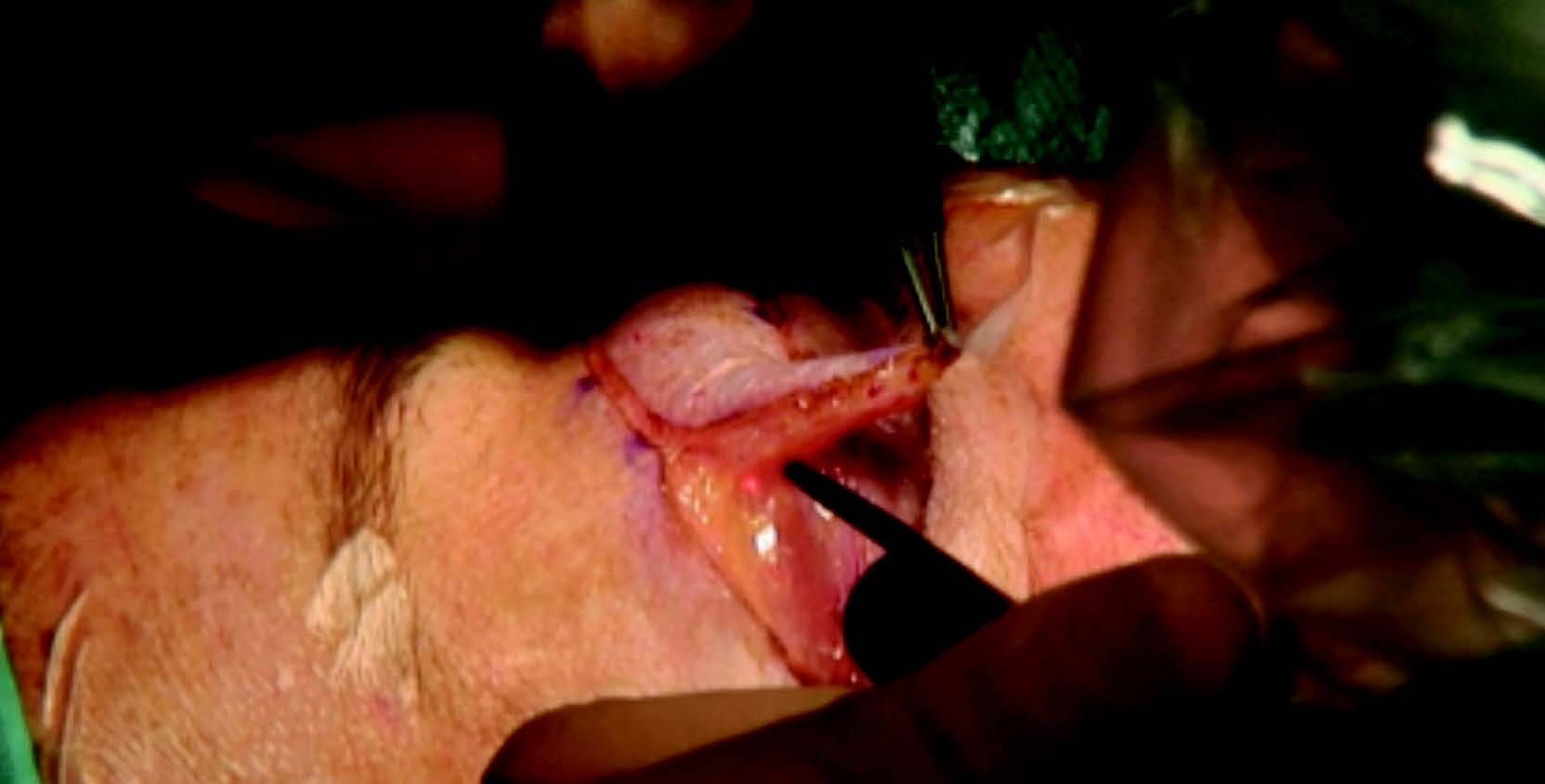 Figure 2. Blépharoplastie supérieure : dissection cutanéo-orbiculaire au laser CO2.
