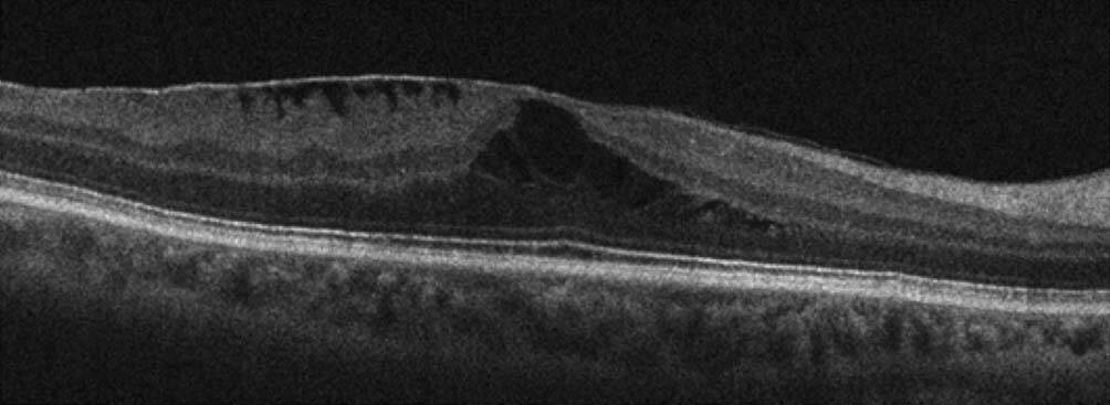 Figure 2. Kystes intrarétiniens associés à la membrane épirétinienne (service d’ophtalmologie de l’hôpital Lariboisière).
