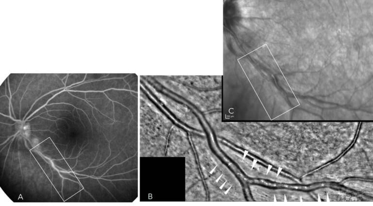 Figure 1. Vascularite veineuse segmentaire visible en imagerie multimodale. A. L’angiographie à la fluorescéine montre une diffusion segmentaire veineuse. B. L’optique adaptative objective l’épaississement de la paroi veineuse diffusant en fluorescéine (la paroi est gris pâle, indiquée par les flèches blanches) et les rétrécissements focaux du calibre vasculaire (astérisques). Image Pr Paques. C. Le cliché infrarouge montre l’épaississement périveineux.
