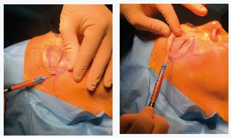 Figure 14. Injection de la graisse.
