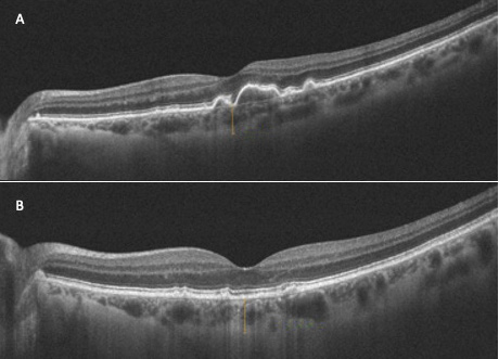 Figure 4. Patiente de 70 ans avec une DMLA intermédiaire du côté gauche. A. Épaisseur choroïdienne initiale avant PBM (274 microns). B. Épaisseur choroïdienne 28,7 mois après (224 microns). 
À noter une franche diminution de la taille des drusen, sans apparition d’atrophie géographique.
