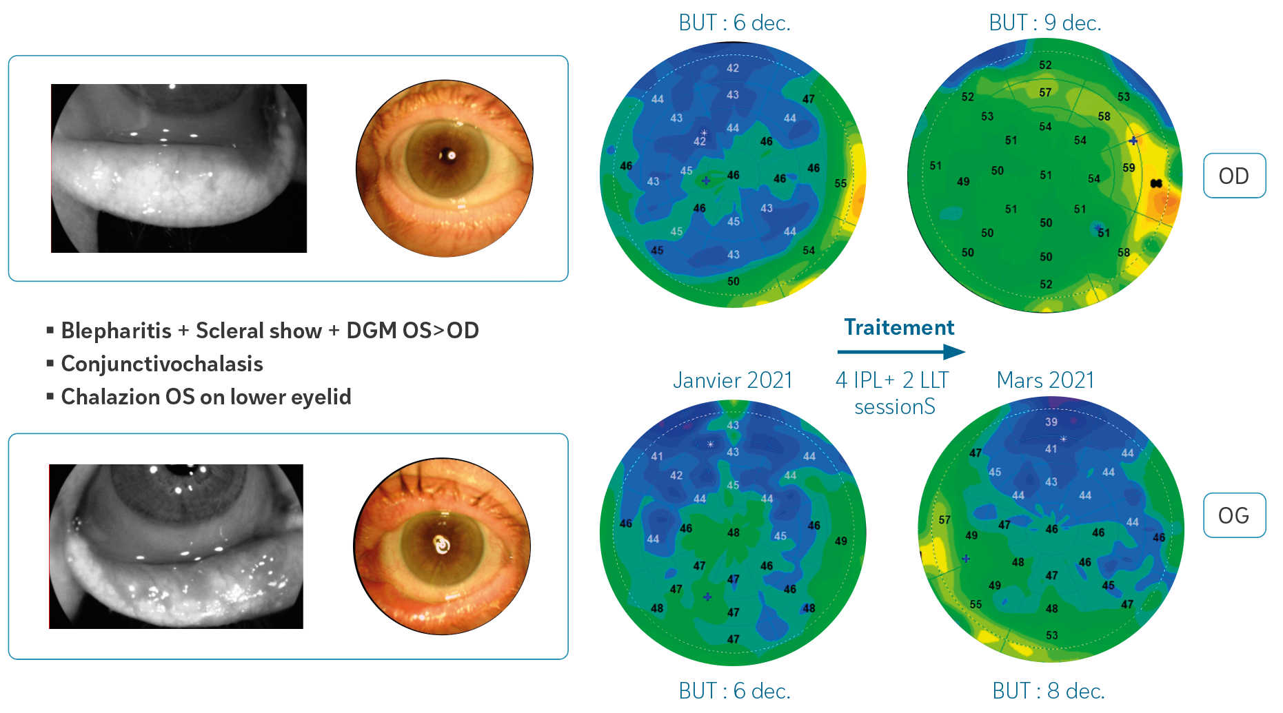 Figure 6A. 

Suivi d’un patient de 66 ans présentant un tableau de blépharite associant un Scleral Show avec de nombreux plis de conjonctivochalasis et un important dysfonctionnement meibomien d’aspect plus prononcé sur l’œil gauche. Après traitement incluant une thérapie combinant 4 séances IPL (Lumenis) et 2 séances LLT lumière bleue (Photobiomodulation, Espansion) ainsi qu’une rééducation du clignement, on observe une amélioration du profil épithélial avec réépaississement de l’épithélium cornéen et augmentation du Break-Up Time.
