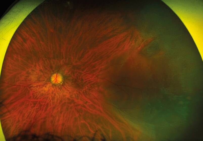 Figure 1. Décollement de rétine rhégmatogène macula-on chez une patiente myope forte porteuse d’une ICL : déchirure en fer à cheval supéro-temporale.
