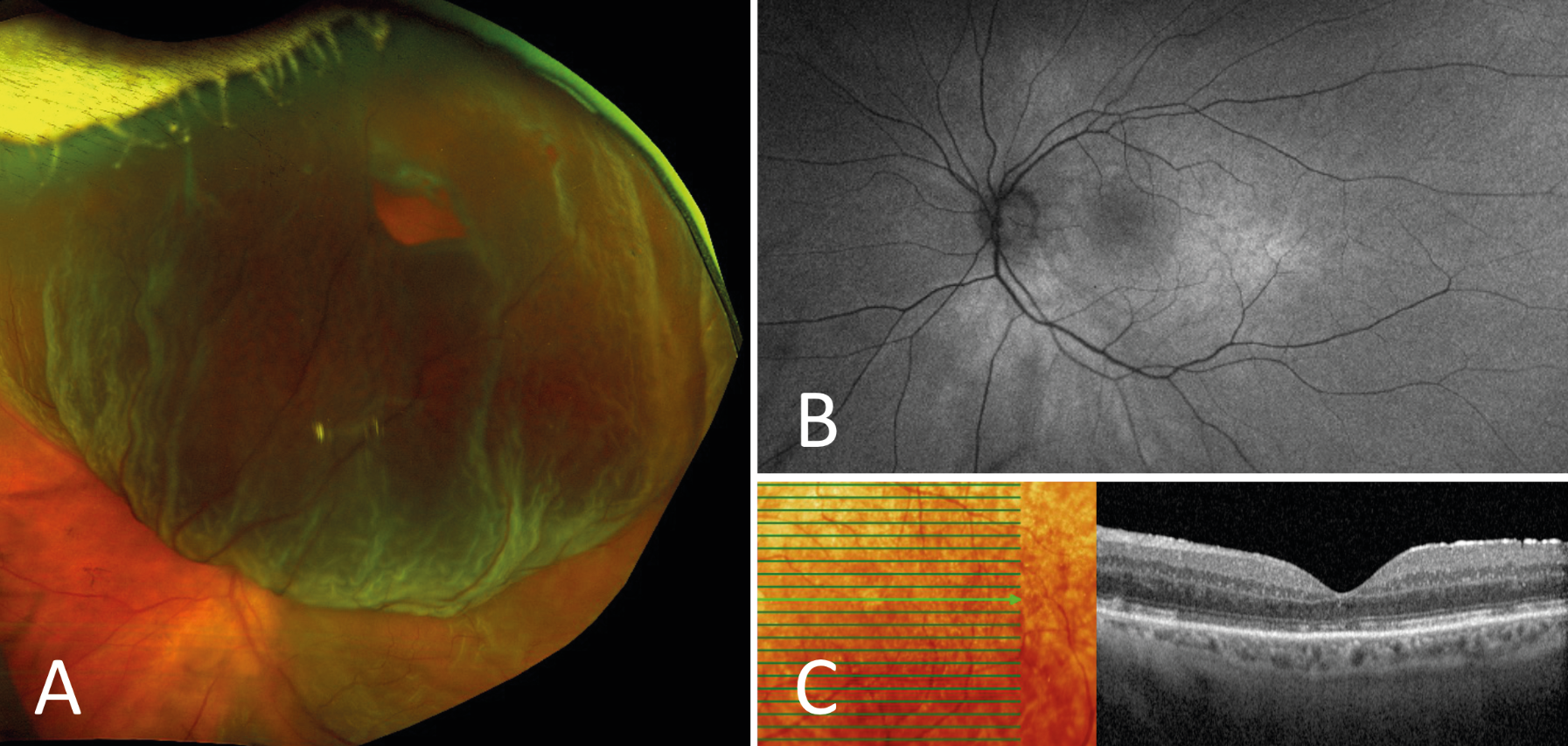 Figure 3. A. Décollement de rétine bulleux supérieur traité par vitrectomie et tamponnement par gaz, suivis d’un positionnement immédiat face vers le sol. B. Absence de déplacement rétinien visible sur l’imagerie en autofluorescence ultra grand champ. C. Le patient rapporte néanmoins des métamorphopsies, expliquées par des altérations des couches externes de la rétine, bien visibles sur l’OCT.
