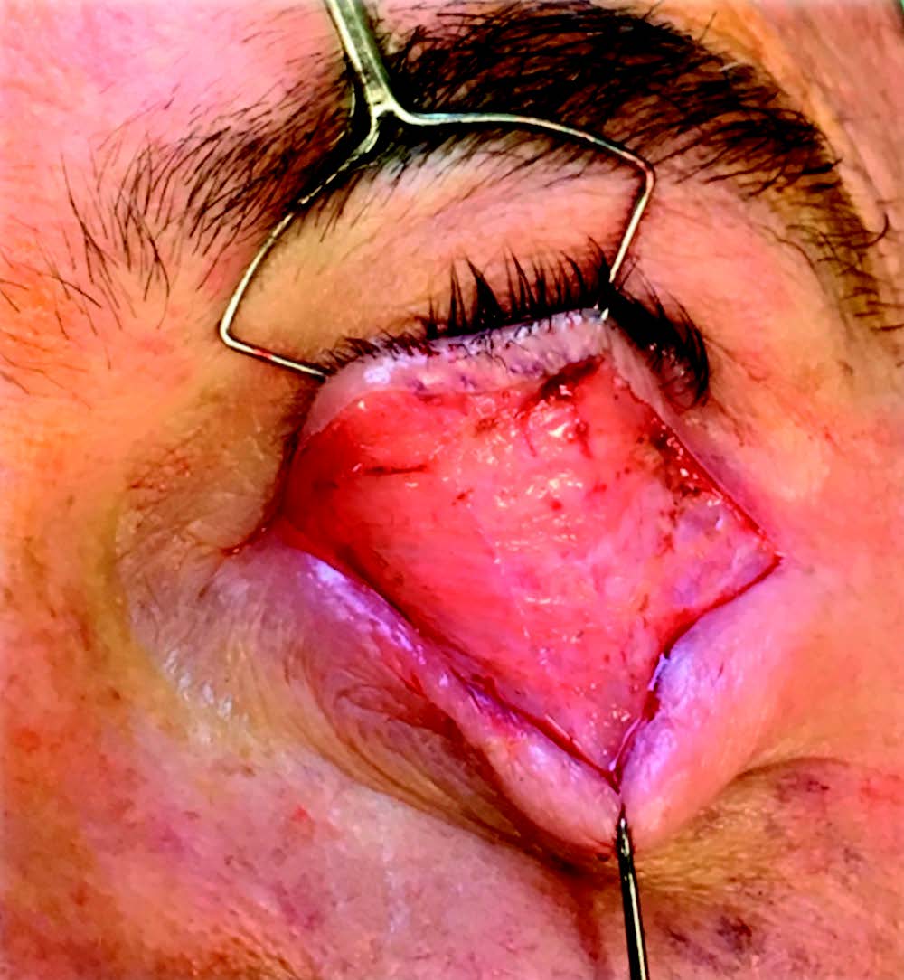 Figure 5. Dépolymérisation du muscle orbiculaire dit à claire-voie.
