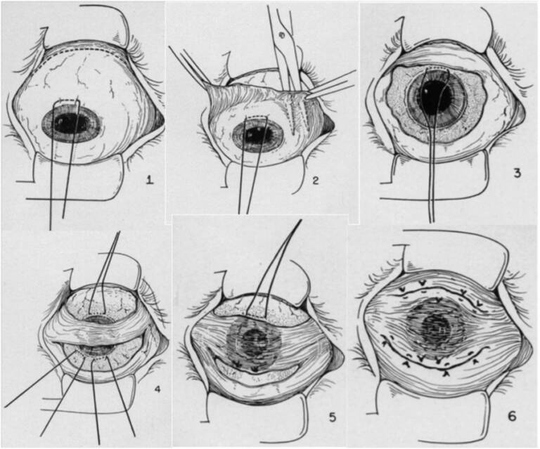 Figure 1. Les différentes étapes chirurgicales du recouvrement (T. Gundersen).

