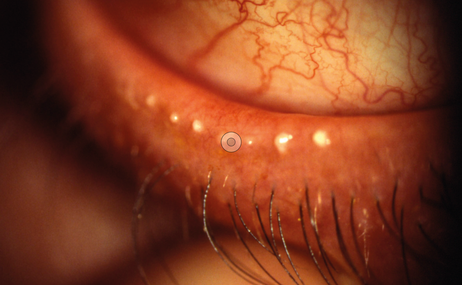 Figure 2 : DGM obstructif avec meibum visqueux
