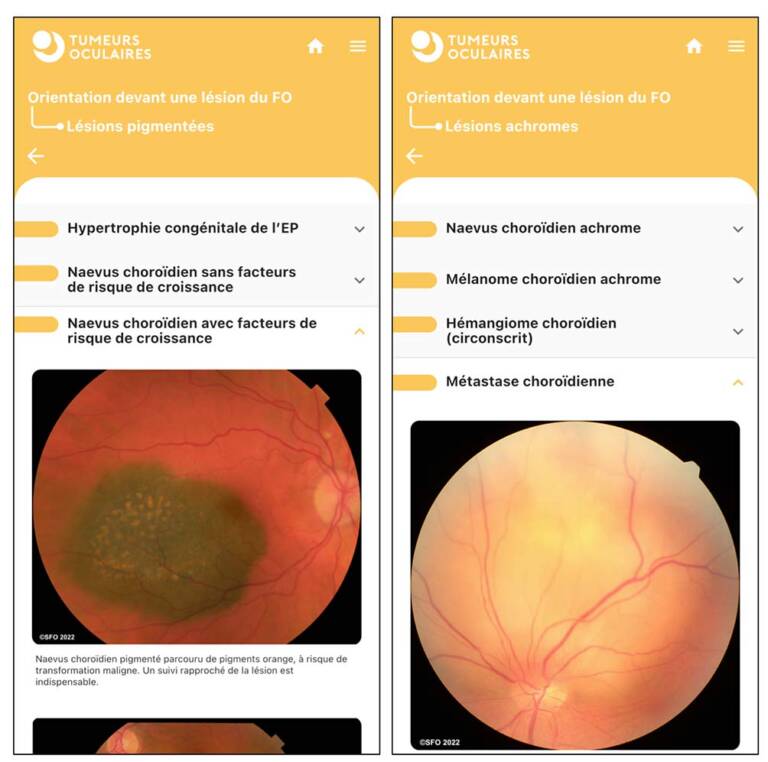 Figure 8. App « Tumeurs oculaires ». Orientation diagnostique devant une tumeur du fond d’œil : lésions pigmentées (gauche) et achromes (droite).
