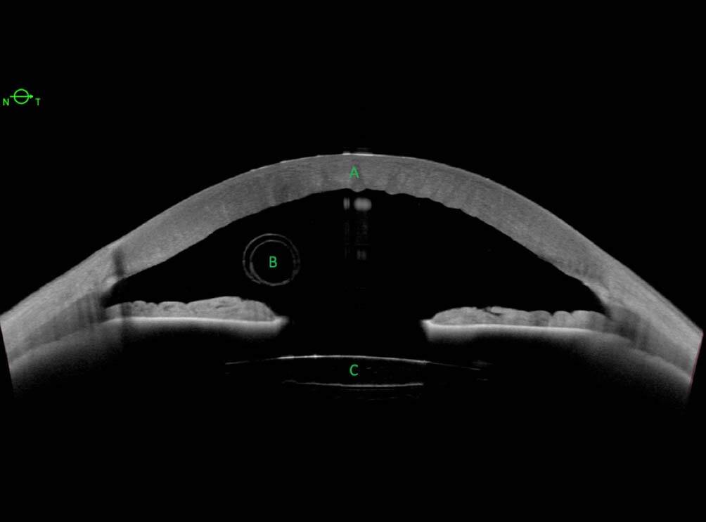 Figure 4. Coupe OCT Swept-Source (Anterion®) de segment antérieur d’un patient ayant été opéré de chirurgie combinée de la cataracte et de Descemet Membrane Endothelial Keratoplasty (DMEK) une semaine plus tôt. Les coupes apportent une information tant sur l’état de la cornée (A), qui présente des plis descemétiques sans opacité, que sur le positionnement du greffon enroulé en chambre antérieure (B), posant l’indication d’une intervention de repositionnement en urgence ou de changement de greffon. La qualité de la résolution et la profondeur de l’image permettent également d’analyser le positionnement de l’implant (C, ici en chambre postérieure non tilté), l’ouverture de l’angle iridocornéen – dont les mesures figurent également sur l’outil Metrics – et la présence d’une iridotomie périphérique dont on pourra juger le caractère transfixiant ou non.
