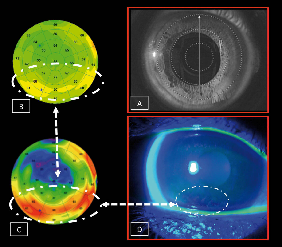 Figure 2.&nbsp; A. Image of a patient’s cornea acquired by OCT imaging using infrared camera. B. Epithelial thickness map highlighting the crescent-shaped region of hyperplasia below the apex. C. Epithelial thickness map using a standardized scale showing the presence of hyperplasia more clearly. D. BUT examination showing the presence of rupture of the tear film caused by a few superficial punctate keratitis lesions at the site corresponding to that of corneal epithelial hyperplasia.
