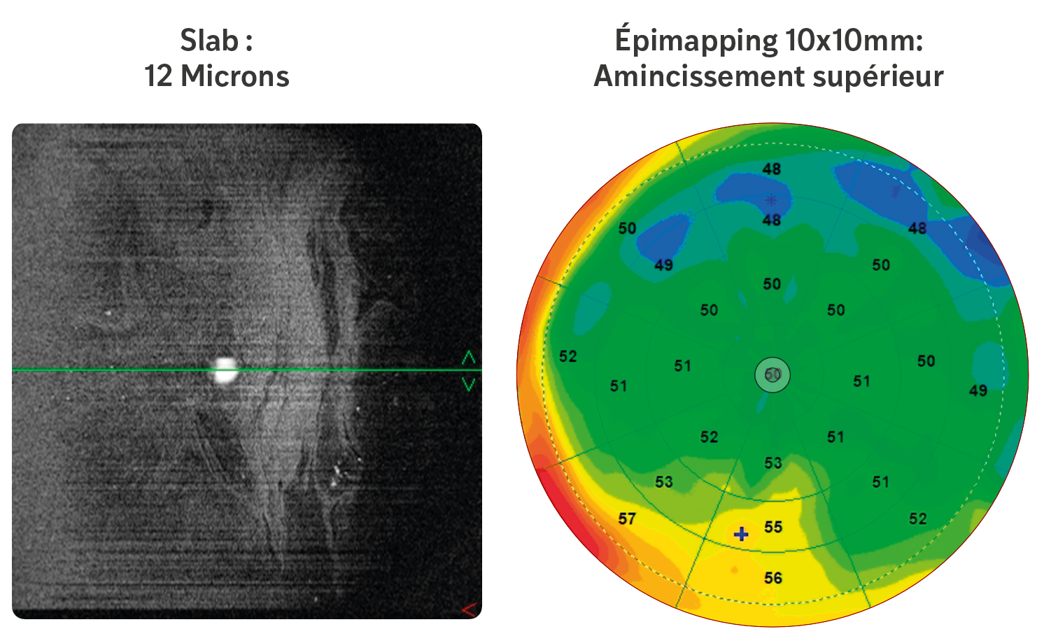 Figure 4. OCT en face, 8 x 8 mm (Solix, Visionix) du film lacrymal avec un slab de 12 microns offrant une belle projection de l’instabilité de la couche lipidique du film lacrymal, avec la correspondance en épimapping où l’on observe un amincissement de l’épithélium cornéen en supérieur, témoin confirmant le stade de sécheresse oculaire.
