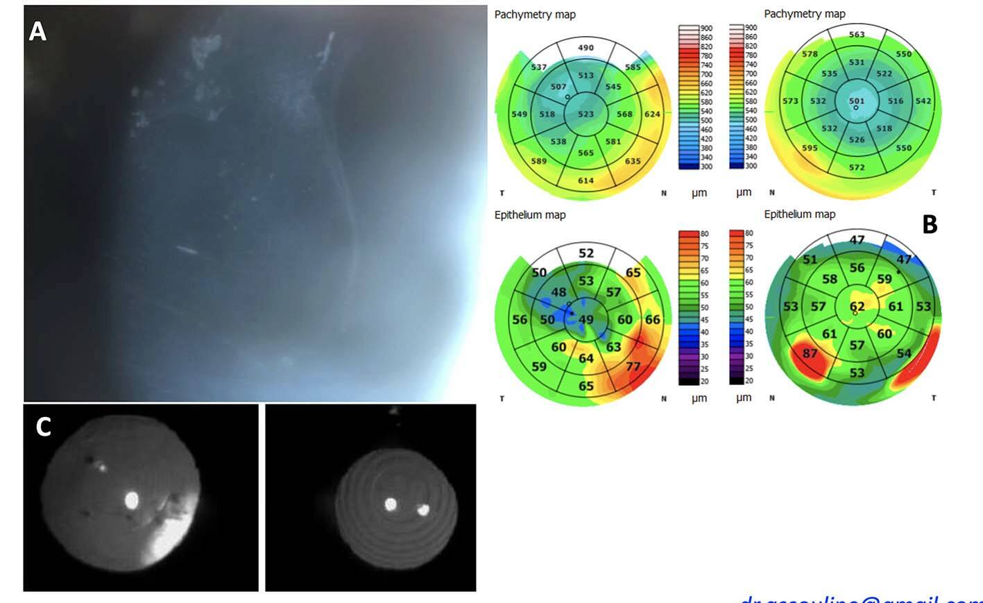 Figure 6. Le Dupixent est un anticorps monoclonal qui bloque l’action de 2 cytokines, les interleukines 4 et 13. Ces protéines jouent un rôle dans les processus inflammatoires impliqués dans la survenue des symptômes de diverses maladies inflammatoires chroniques, telle la dermatite atopique, l’asthme, la polypose nasale. Environ 40 cas de kérato-conjonctivites iatrogènes ont été rapportés. Nous décrivons ici le premier cas de dystrophie de Cogan (Map Dot Fingerprint Dystrophy) induite par le Dupixent chez un patient que nous suivions depuis plusieurs années et qui a développé en quelques semaines une symptomatologie typique (kératalgie nocturne et au réveil, associée à un aspect sous-épithélial caractéristique (A) : l’irrégularité épithéliale est bien visible sur l’œil droit en rétro-illumination sur les cartes épithéliales (B) et en rétro-illumination, de façon superposée à l’image des implants multifocaux (C). Ces anomalies ont disparu en 3 mois à l’arrêt du traitement.
