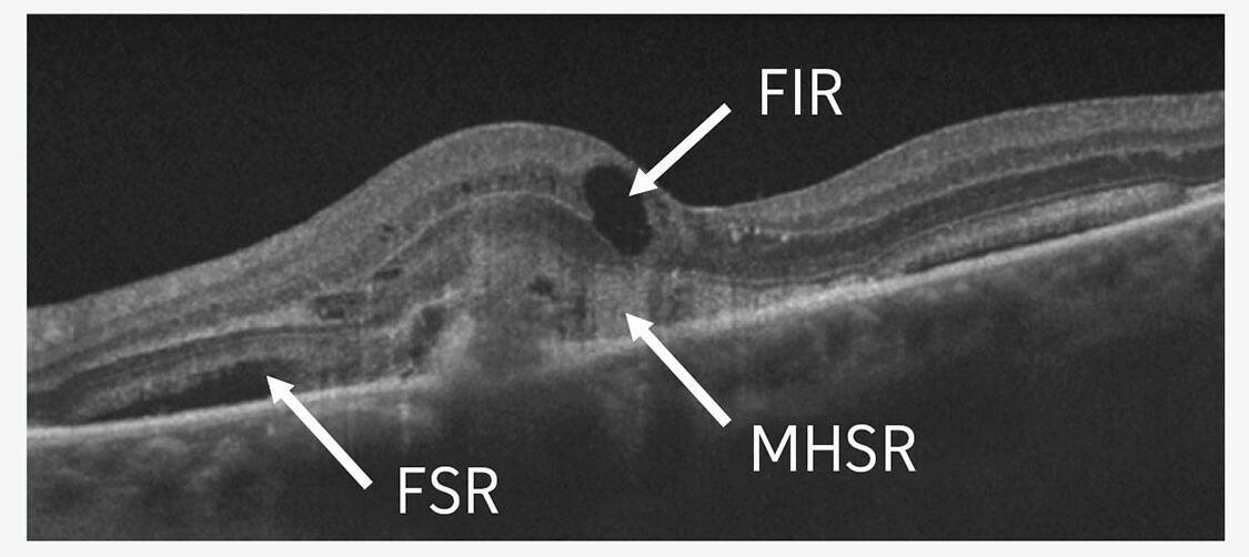 Figure 3. Les différents types de fluides dans la rétine : fluide sous-rétinien (FSR), fluide intrarétinien (FIR), matériel hyperréflectif sous-rétinien (MHSR).

