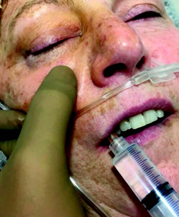 Figure 5. Abord intrabuccal du nerf infraorbitaire.
