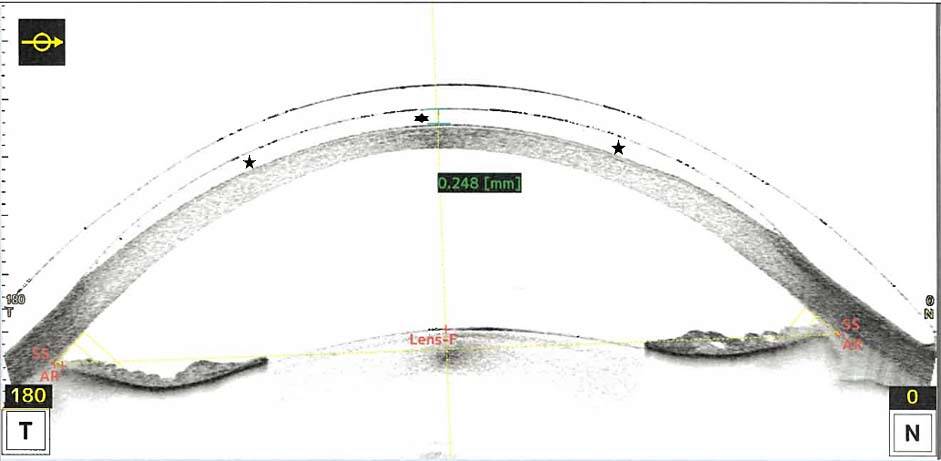 Figure 1. Coupe 0°/180° en OCT segment antérieur (Casia). La lentille sclérale passe en pont au-dessus de la cornée et du limbe et vient se poser sur la sclère. Il existe un espace liquidien entre la lentille et la cornée.
