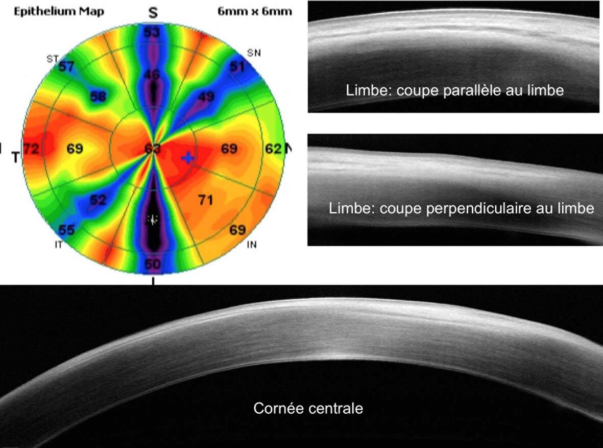 Figure 5. Insuffisance limbique : aspect en rayons de roue du mapping épithélial. Perte de la structure de la niche limbique sur les coupes limbiques. Hyperréflectivité de l’épithélium cornéen central.
