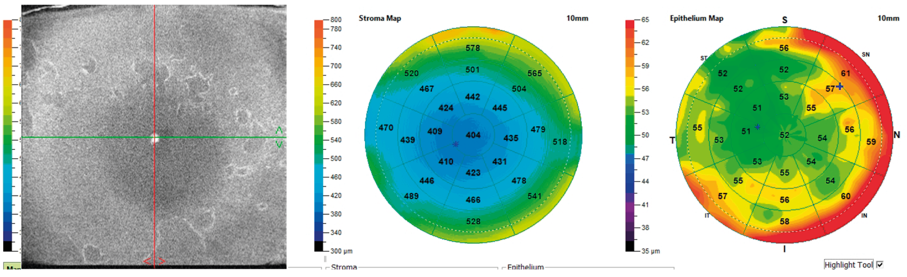 Figure 5. OCT en face, 8 x 8 mm (Solix, Visionix) de l’épithélium dans une dystrophie de Cogan débutante avec plis de la basale se présentant comme de petits îlots avec des contours hyperréflectifs en rapport avec les plis de la membrane basale, en corrélation avec l’épimapping qui met en évidence des zones d’hyperplasie caractéristiques de cette dystrophie.
