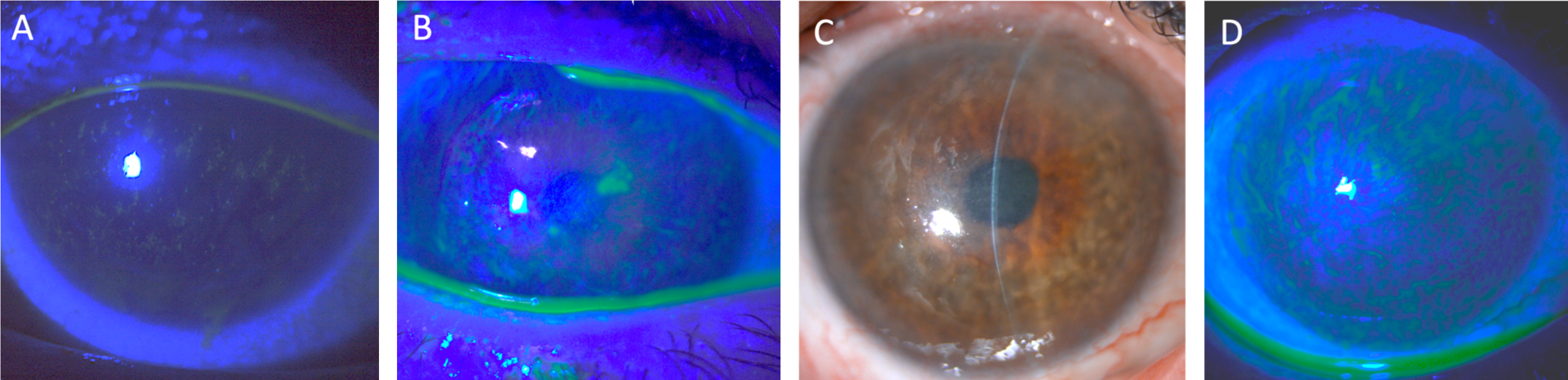Figure 1. Exemples d’indications du collyre au sérum autologue. (A) Kératite ponctuée superficielle en motte chez une patiente présentant une kératoconjonctivite sèche sévère de Gougerot-Sjögren, stabilisée par l’instillation de 4 gouttes quotidiennes de collyre au sérum autologue à 20 %. (B) Ulcère neurotrophique associé à une insuffisance limbique post-radique secondaire à un carcinome épidermoïde conjonctival. (C, D) Même patiente : cicatrisation complète de l’ulcère neurotrophique après traitement par 6 gouttes quotidiennes de collyre au sérum autologue à 20 %. Persistance d’une persistance de l'insuffisance limbique, mais amélioration notable de l’inconfort oculaire.
