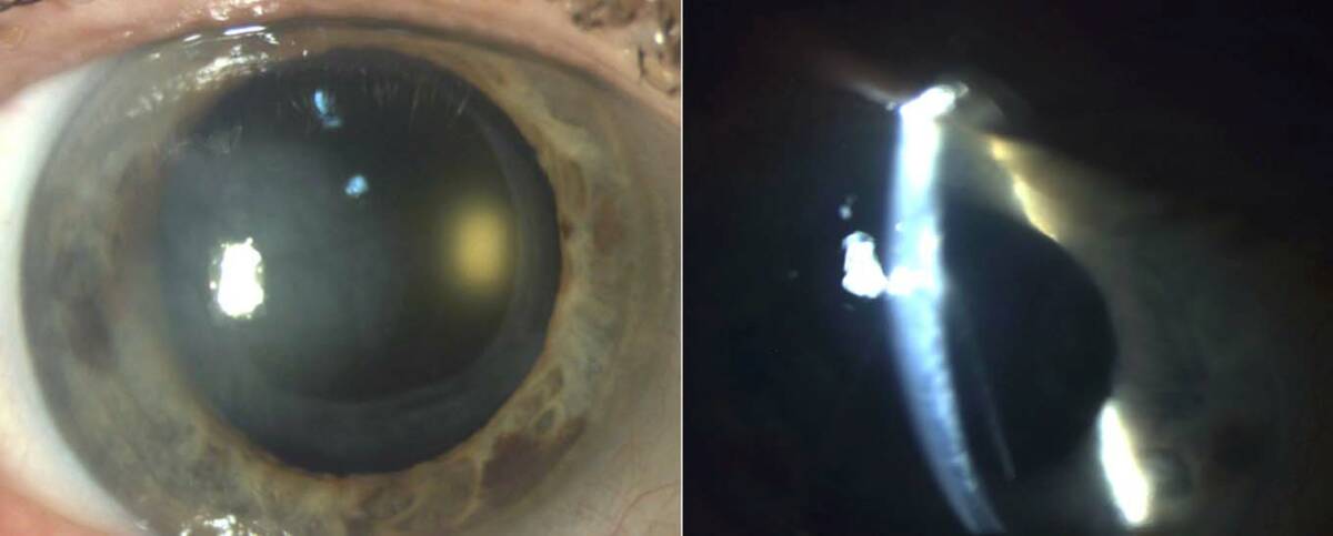 Figure 1. Examen lampe à fente : à droite, œdème sectoriel en regard de l’incision de la chirurgie de la cataracte ; à gauche, décollement de la membrane descemétique.
