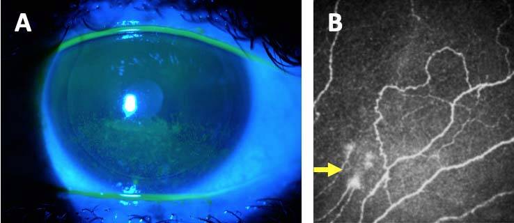 Figure 5. A. Examen biomicroscopique après instillation de fluorescéine. Sécheresse oculaire sévère à 8 mois d’une procédure Lasik associée à des douleurs de type neuropathique. B. Image en microscopie confocale objectivant la présence de névromes pouvant expliquer une partie des symptômes.
