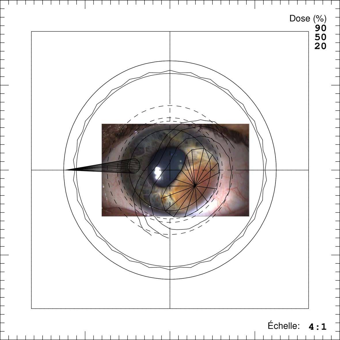 Figure 4. Plan de traitement en protonthérapie d’un mélanome de l’iris sans pose de clips de repérage.
