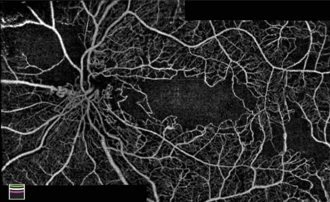 Figure 2.  OCT-angiographie grand champ 18 mois après protonthérapie d’un mélanome choroïdien, montrant une rétinopathie, une maculopathie et une papillopathie radiques.
