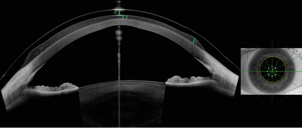 Figure 3. Coupe OCT Swept-Source (Anterion®) de segment antérieur d’un patient adapté en lentilles sclérales. On retrouve sur cette coupe horizontale la lentille sclérale (A), la clearance apicale (B) et la clearance limbique (C). L’adaptation de ce patient présentant une cornée irrégulière est facilitée par la qualité et la reproductibilité des mesures.
