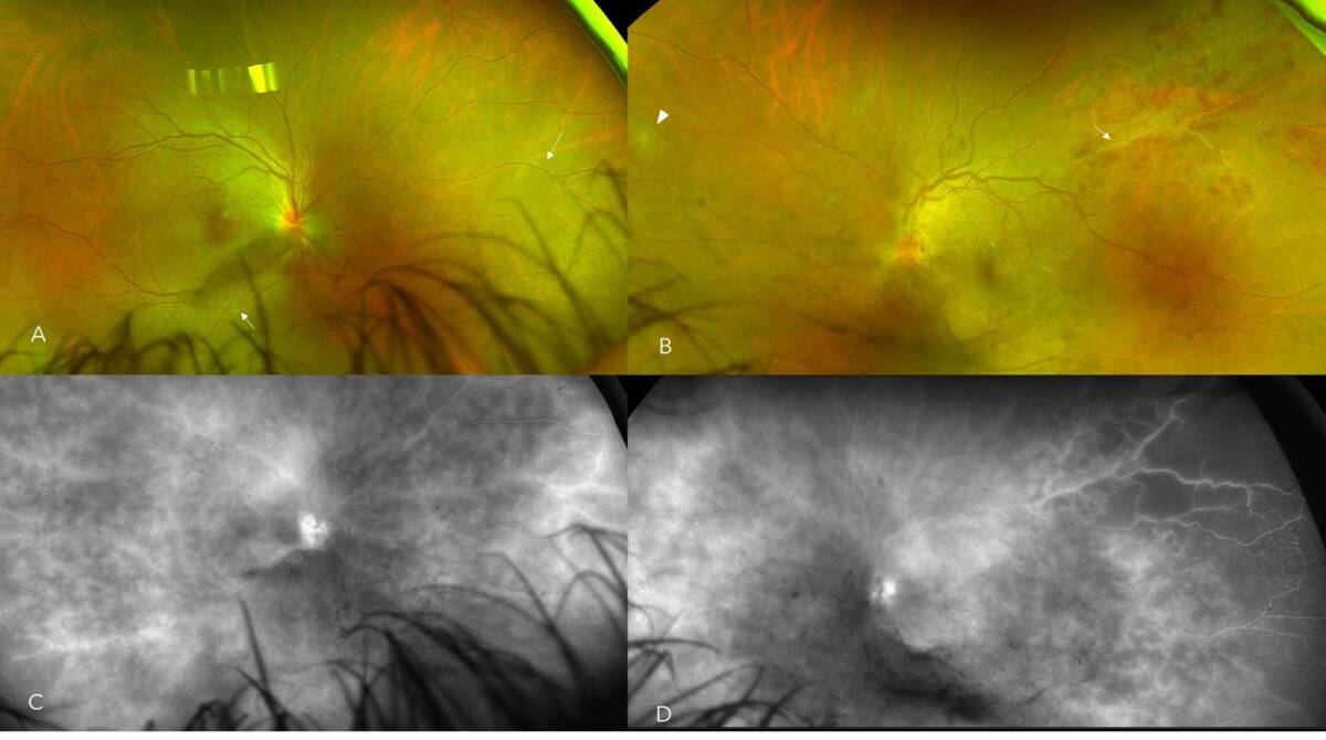 Figure 3. A et B. Maladie de Behçet. Sur les rétinophotographies ultra grand champ, on remarque la présence d’engainements vasculaires bilatéraux (flèches), d’une vascularite veineuse occlusive sur l’œil gauche avec un vaisseau fantôme et des hémorragies rétiniennes, une hyalite et un infiltrat intrarétinien (tête de flèche). C et D. L’angiographie fluorescéine ultra grand champ révèle une capillaropathie bilatérale diffuse très sévère en feuilles de fougère et une ischémie rétinienne temporosupérieure de l’œil gauche.
