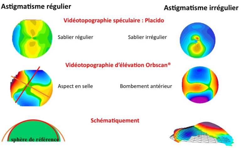 Figure 1. Astigmatisme régulier vs irrégulier (topographie spéculaire Placido et par fente Orbscan®).
