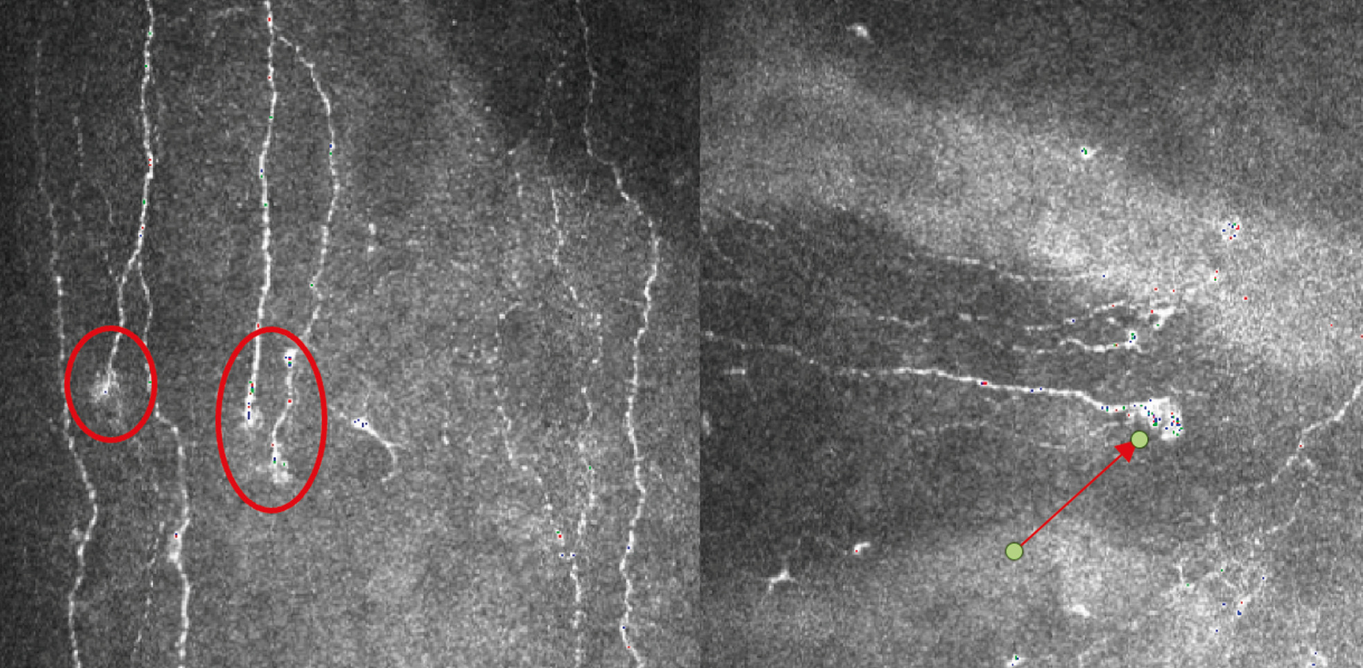 Figure 1. Micronévromes (à gauche) sur les terminaisons nerveuses. Névrome (à droite), isolé, avec densité nerveuse faible. (Source : CHU de Bordeaux, CRNK).
