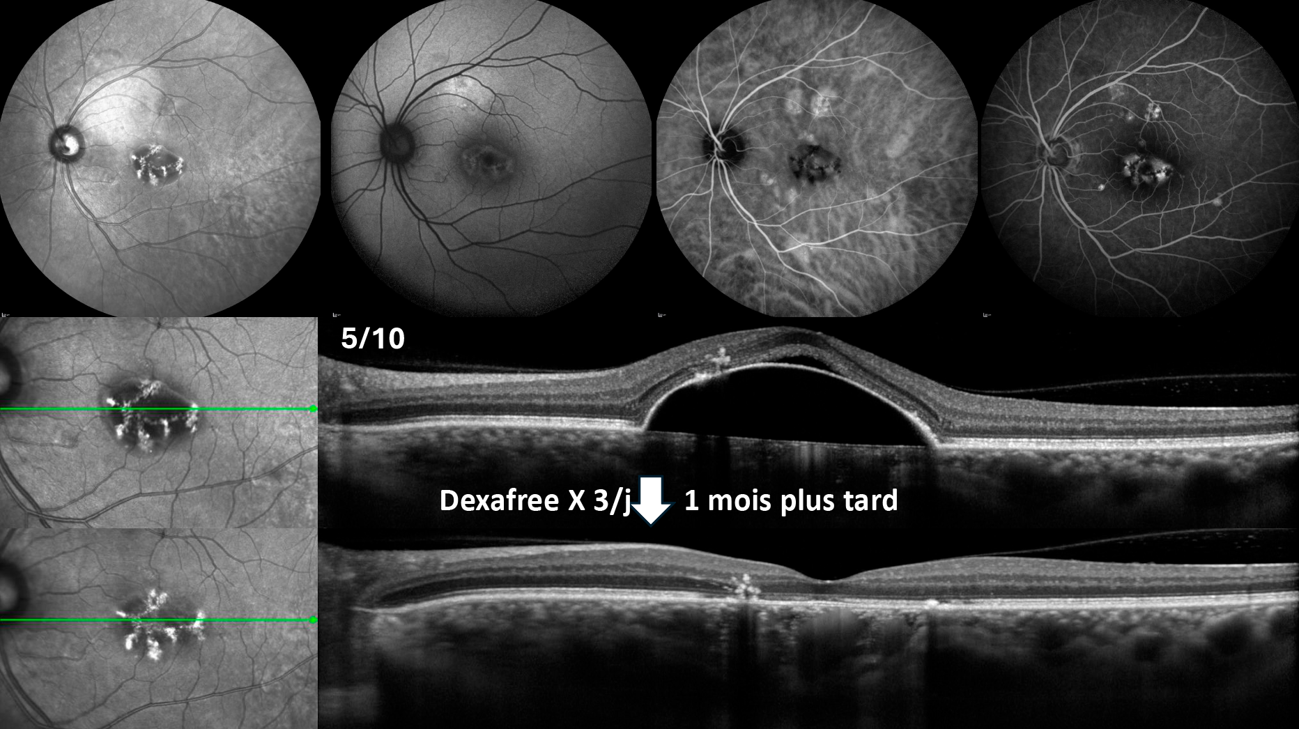 Figure 1. Exemple de patient avec une CRSC et un volumineux DEP séreux rétrofovéolaire responsable d’une baisse d’acuité visuelle à 5/10. Le DEP séreux s’est complètement affaissé 1 mois après un traitement par dexafree collyre 3 fois par jour.
