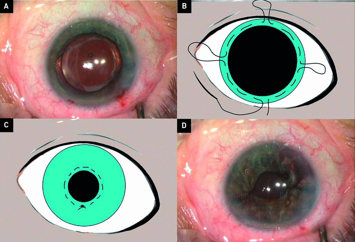 Figure 2. Réparation d’une mydriase paralytique par la technique du lasso. A. Aspect préopératoire d’une mydriase paralytique sans défect irien. B. Multiples passages d’un fil de polypropylène 10-0 à travers le stroma irien sur tout son diamètre. C. Le lasso est serré et maintenu par un nœud coulissant afin de fermer la pupille. D. Aspect postopératoire.
