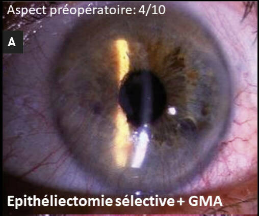 Figure 2. Épithéliectomie sélective + GMA. A. Aspect préopératoire : 4/10.&nbsp;
