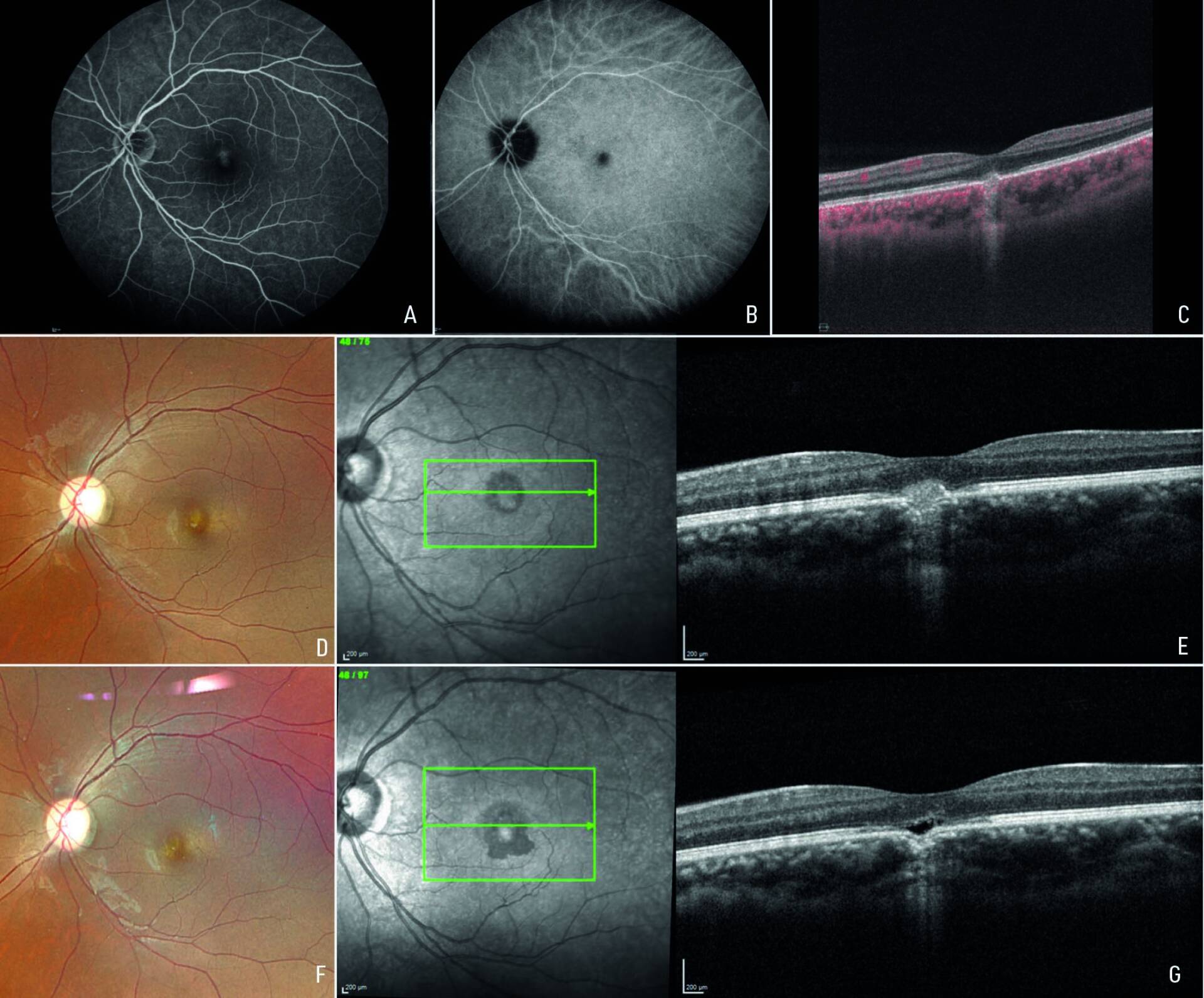 Figure 3. Jeune femme 29 ans, avec une faible myopie, sans antécédents. Scotome central gauche avec acuité à « compte les doigts ». Présence d’une lésion jaunâtre maculaire (D) correspondant à une lésion hyperréflective en OCT (E) avec interruption de la ligne ellipsoïde et de l’épithélium pigmentaire et hypertransmission postérieure. L’angiographie à la fluorescéine (A) montre une très minime diffusion. En angiographie au vert d’indocyanine (B), la lésion reste hypofluorescente jusqu’aux temps tardifs, l’OCT-angiographie Plexelite (C) exclut la présence d’un flux au sein de la lésion. Il s’agit donc d’une PIC maculaire sans complication néovasculaire traitée par corticoïdes et azathioprine, avec une évolution vers l’invagination du complexe Bruch-épithélium pigmentaire (G) vers la choroïde et un espace hyporéflectif en avant. La vision remonte à 8/10.
