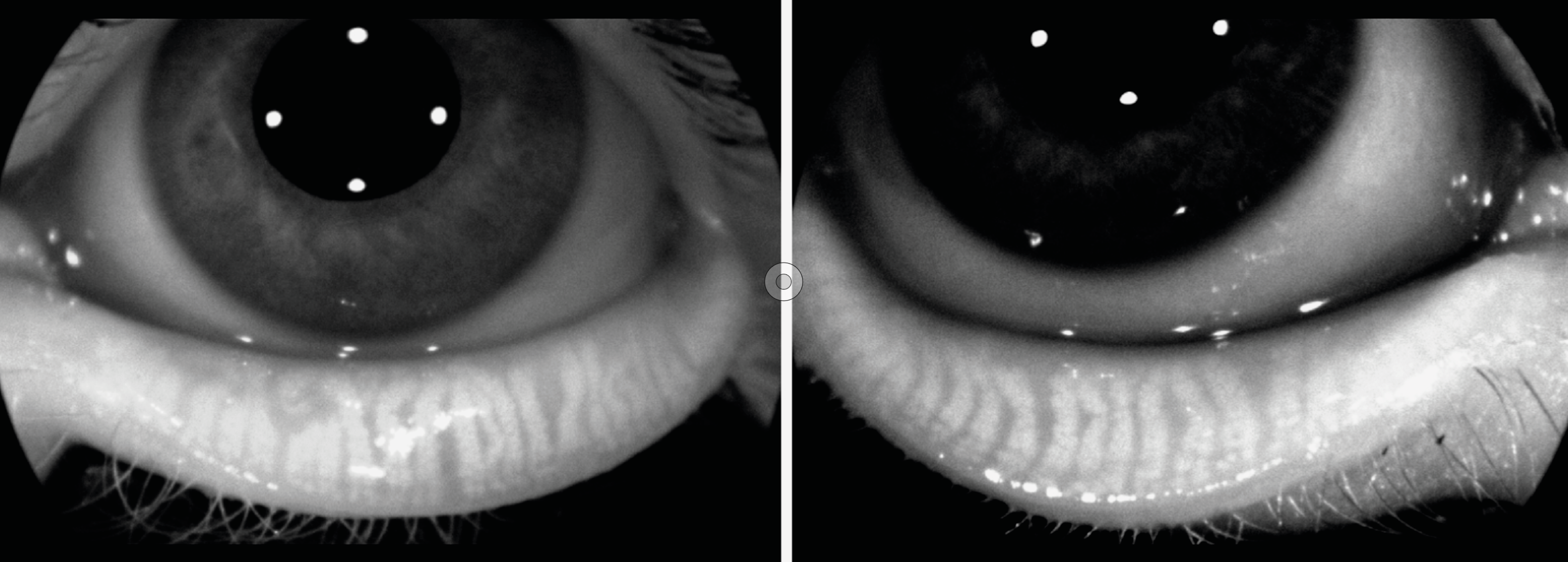 Figure 3. Meibographie embarquée dans la plateforme OCT Solix (Visionix) mettant en évidence un dysfonctionnement meibomien de stade 1-2.
