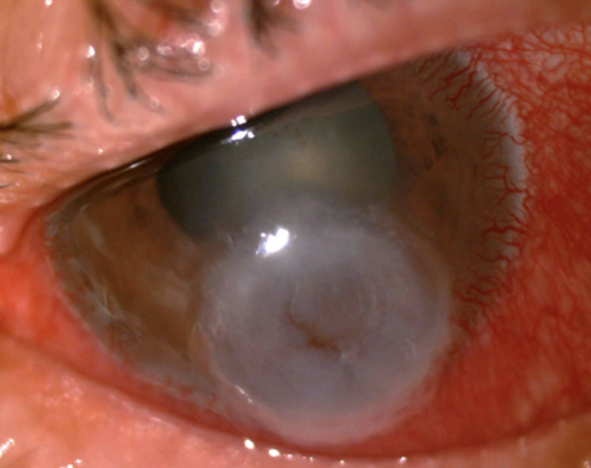 Figure 1. Abcès sévère à Streptococcus pneumoniae : notez l’aspect nécrosant de l’infiltrat.
