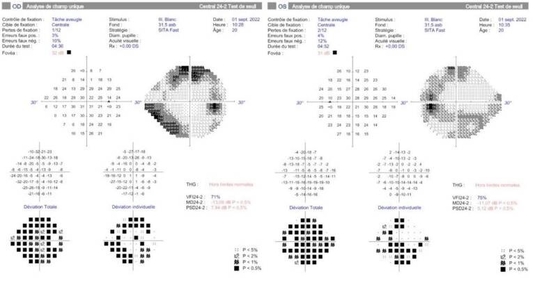 Figure 7. Champ visuel 24,2 aux 2 yeux, déficit diffus (Zeiss Humphrey – CHBA Vannes, service d’ophtalmologie).
