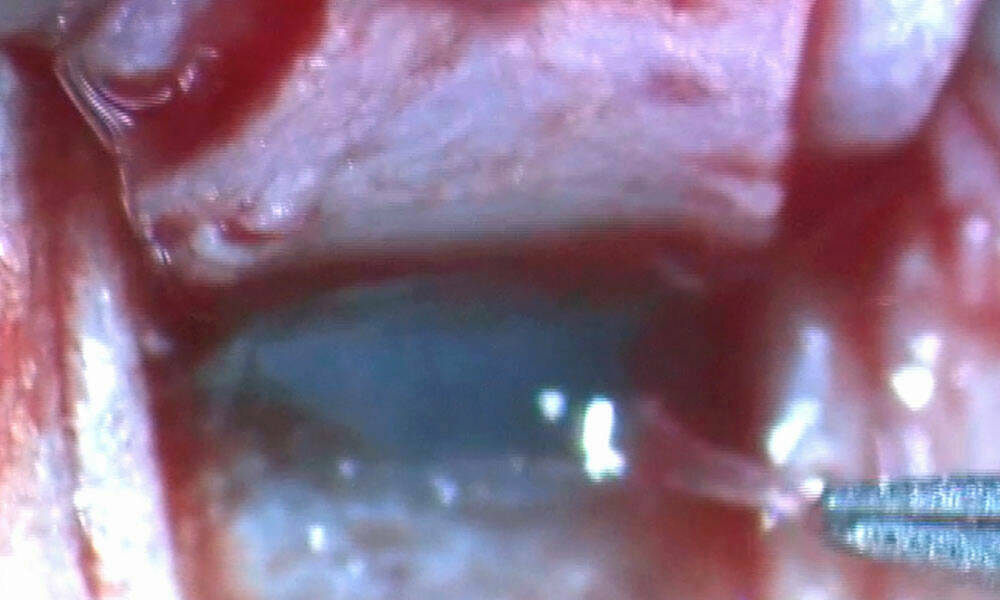 Figure 2. Le trabéculum juxtacanaliculaire dans la pince lors d’une sclérectomie profonde. C’est ce trabéculum qui offre 80 % de la résistance à l’écoulement de l’humeur aqueuse par la voie trabéculaire.
