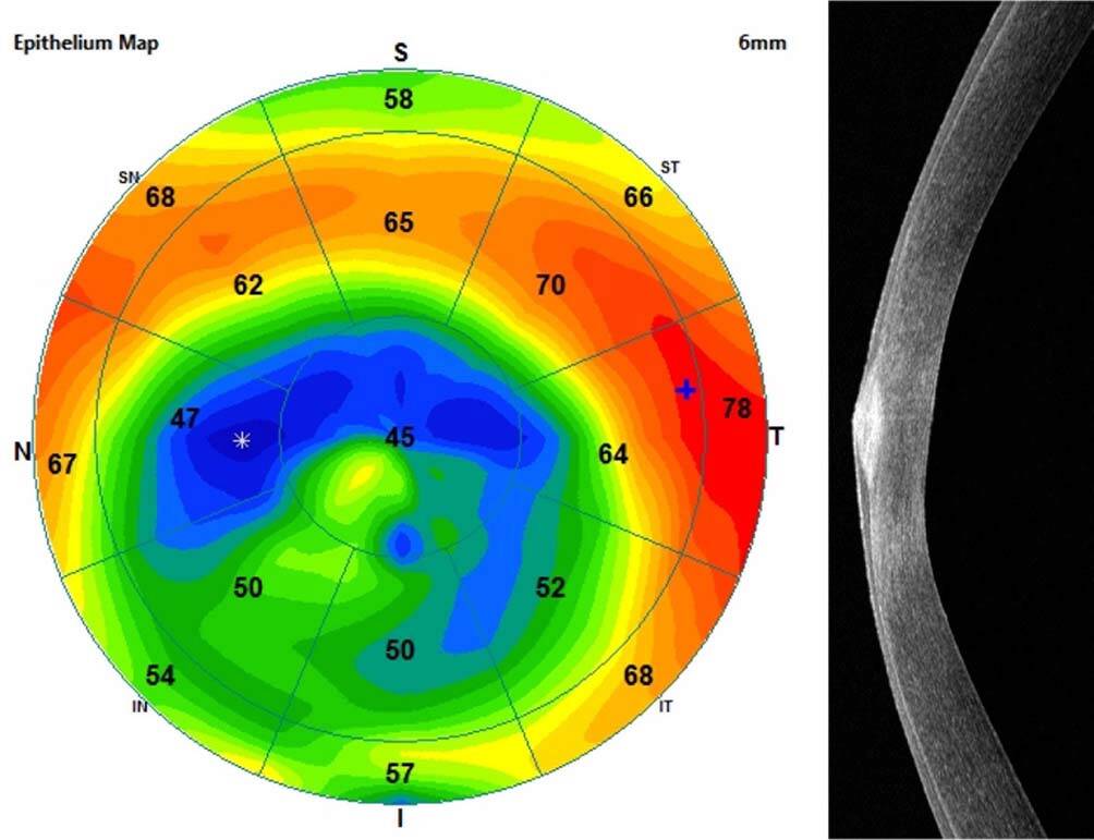 Figure 2. Kératocône : aspect en donut du mapping épithélial (amincissement épithélial au sommet du cône entouré d’une couronne d’épaississement épithélial).
