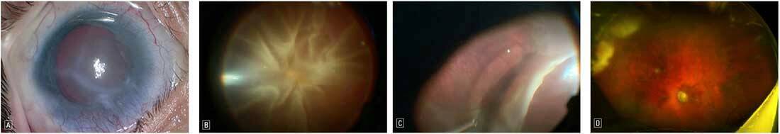 Figure 4. Décollement de rétine chez un patient atteint d’un glaucome congénital et prise en charge chirurgicale. A. Opacités du segment antérieur liées au glaucome, rendant difficiles l’examen du fond d’œil et la chirurgie. B. Photographie peropératoire : décollement de rétine total. C. Photographie peropératoire : déhiscence périphérique responsable du décollement de rétine. D. À 3 mois postopératoires, la rétine est à plat sous tamponnement par huile de silicone.

