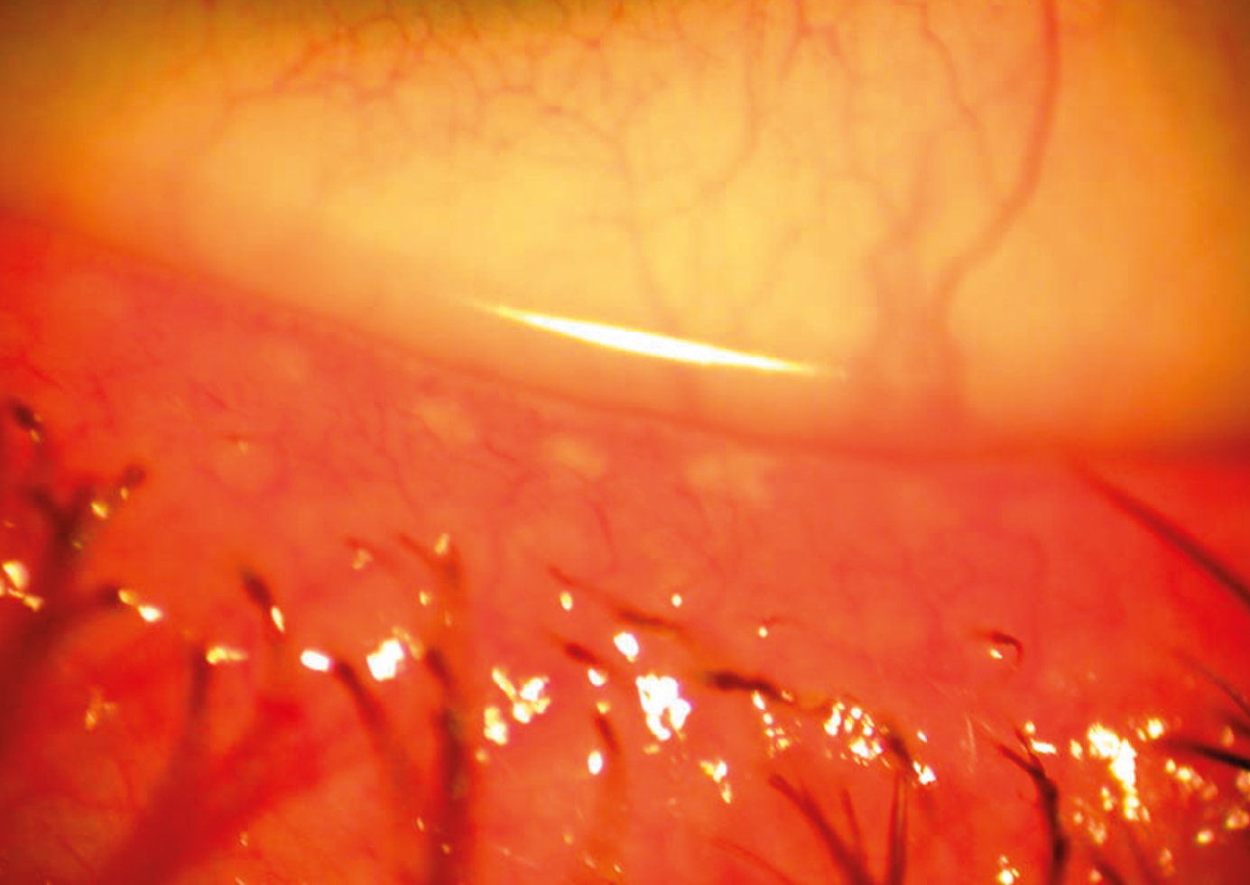 Figure 1 : Blépharite postérieure
