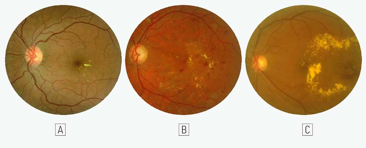 Figure 1. Différents aspects de TelCaps au fond d’œil chez 3 patients diabétiques.
Chez ces 3 patients, les exsudats, de densité variable, sont l’anomalie la plus évidente et témoignent de l’exsudation active, localisée. La télangiectasie capillaire à l’origine de l’exsudation, d’aspect le plus souvent rouge sombre, est souvent peu ou mal visible. Elle doit être recherchée au centre de la couronne d’exsudats.
